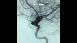 WEB Treatment of Unruptured 7 mm MCA Aneurysm [upl. by Cressi]