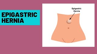 Epigastric hernia  symptoms clinical features [upl. by Shugart]