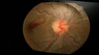 Yag Laser Hyaloidotomy for a pre macular haemorrhage [upl. by Berner]