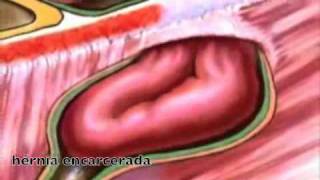 GASTROCIRURGIA  Vídeos  Hérnia Encarcerada [upl. by Straus]