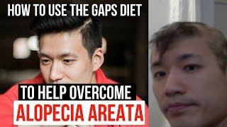 How to use the GAPS diet for alopecia areata [upl. by Mailliw]