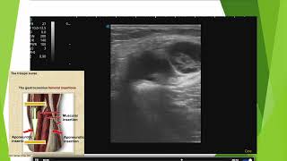 Aspect dune rupture de kyste poplité en échographie [upl. by Netnert503]
