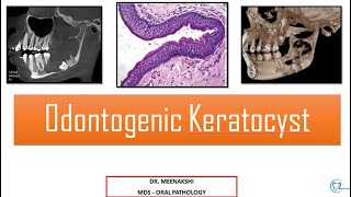 Odontogenic Keratocyst [upl. by Ahcas]