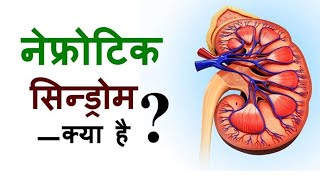 Nephrotic Syndrome in Hindi नेफ्रोटिक सिंड्रोम हिंदी में [upl. by Merow673]