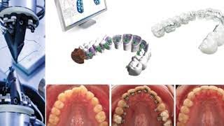 ORTODONCIA LINGUAL  CEMENTACIÓN INDIRECTA DE BRACKETS LINGUALES 2D Forestadent [upl. by Nyar]