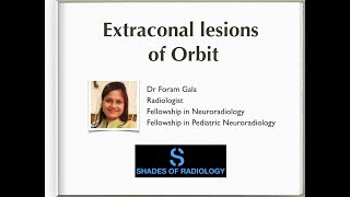 Extraconal lesions of Orbit Simplified [upl. by Roby]