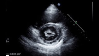 Mitral stenosis Quantifications Planimetry tips and tricks [upl. by Brok]