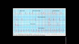 Ambulatory ECG [upl. by Daye]