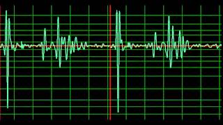 Minor Cardiomyopathy normal speed [upl. by Nabi]