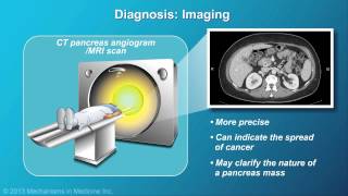 Pancreatic Cancer Pathophysiology Diagnosis and Staging [upl. by Aiclef246]