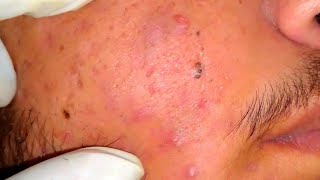 sac be spa blackheads elderly 2024  sac be spa old age blackheads 2024  sac be spa thuy 777 [upl. by Avle]