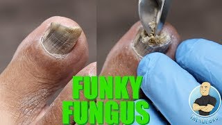 HAVE NAIL FUNGUS YOU NEED TO BE DOING THIS SUPER IMPORTANT TIP [upl. by Bresee]