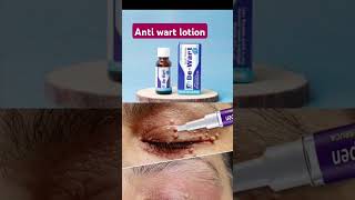 Wart tratment in urduDe wart lotionUses benefits sideeffect and advanteges in urdu [upl. by Enitram]