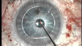 Raindrop ReVision Optics Inlay for Presbyopia Insertion Technique [upl. by Trebbor]