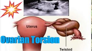 Level 3  Female pelvis  Gyn  Ovary Torsion [upl. by Jat]