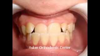 Acase report of orthodontic pseuo class III at Asker Orthodontic Center by DrAmr Asker [upl. by Maddy]