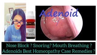 Nose Block Snoring Best Homeopathic Medicine Adenoids Homeopathic Treatments DrRukmani Choudhary [upl. by Ahseikram]