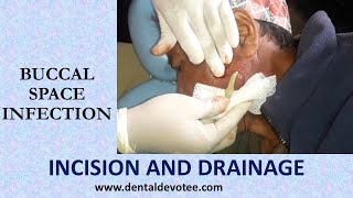 Incision and Drainage of Buccal space infection by Dr Raman Dhungel [upl. by Leirud]