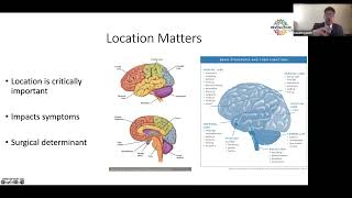 The Glioblastoma Brain Cancer Patient Journey DEMYSTIFIED [upl. by Sivrep]