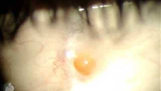 Pyogenic Granuloma on Eye [upl. by Ahselyt]