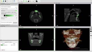 Converting file dicom to stl for free with Invesalius [upl. by Akirdnwahs]