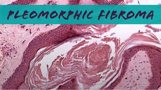 Pleomorphic fibroma looks like skin tag but relative of spindle cellpleomorphic lipoma pathology [upl. by Eeltrebor]