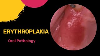 Erythroplakia  Oral pathology  NEET MDS  Dental Care [upl. by Nyleuqaj44]