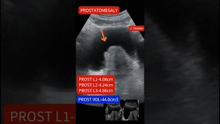 Ultrasound showing Enlarged prostateprostatomegaly ultrasound [upl. by Rhona]