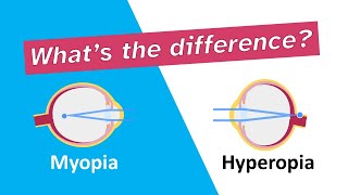 Whats the difference between myopia nearsightedness and hyperopia farsightedness [upl. by Eniamurt]