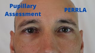 Pupillary Assessment PERRLA [upl. by Redmond]