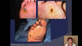 Corn amp Callus Debridement by a Podiatrist [upl. by Ellard]