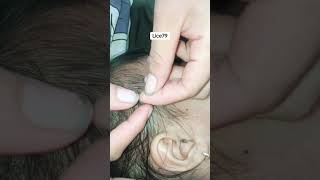 banyak Kuto lice satisfying removal relaxing [upl. by Essam]