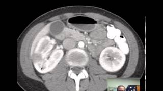 CT Kidneys and Bladder  Five pathologic cases discussed [upl. by Madra]