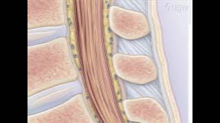 lumbar puncture [upl. by Bierman]