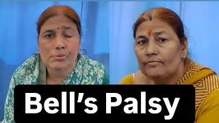 Bell’s Palsy Patient Review Recovery Dr Pritam Singh  Jigars physiotherapist [upl. by Nollek652]