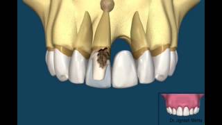 Bridge Vs Dental Implant [upl. by Akem]