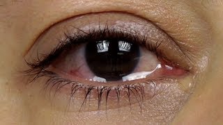 How to stop watery eyes  Dr Sunita Rana Agarwal [upl. by Hendon]