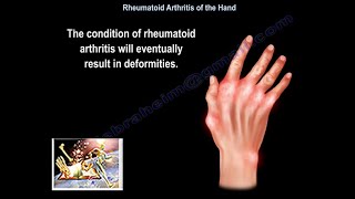 Rheumatoid Arthritis Of The Hand  Everything You Need To Know  Dr Nabil Ebraheim [upl. by Atenek614]