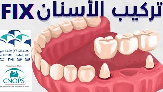 🦷 CNOPS CNSS كل ما يخص تركيب الأسنان الفيكس [upl. by Adihsaar155]