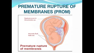 Premature rupture of membranes PROM [upl. by Pelmas]