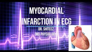 Myocardial Infarction MI ECG in HIndi [upl. by Asha254]