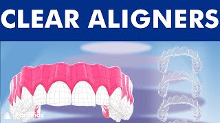 INVISALIGN  Orthodontic treatment with CLEAR ALIGNERS © [upl. by Araes]