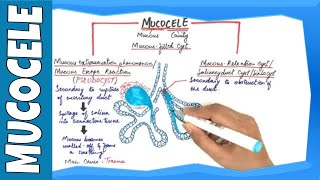 Mucocele  Types Clinical Features Histopathalogic features amp Treatment [upl. by Sarkaria]