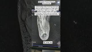 MRI Ankle Showing tenosynovitis in t2trimtra Sequence beginners [upl. by Mitzie633]