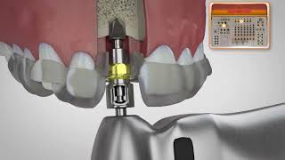 BioHorizons Pro Surgical Kit Drilling Sequence Keyless Guided Surgery [upl. by Woll480]