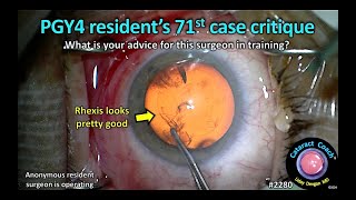 CataractCoach™ 2280 PGY4 residents 71st cataract case critique [upl. by Einatirb]