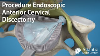 Procedure Endoscopic Anterior Cervical Discectomy [upl. by Naahs]