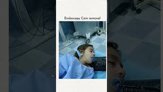 Endoscopy coin removel [upl. by Ronyar]