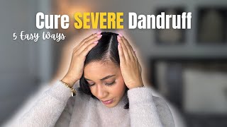 5 Easy Ways To Cure Severe Dandruff Seborrheic Dermatitis [upl. by Aneba]