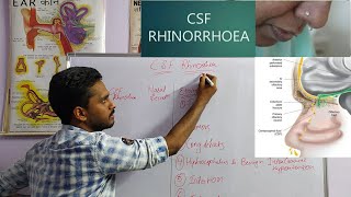 CSF RHINORRHEA  ENTNOSE [upl. by Featherstone]